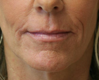 Juvederm in Nasal-labial folds