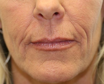 Juvederm in Nasal-labial folds