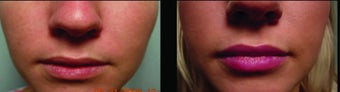 Restylane