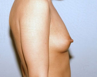Breast Augmentation for Young Woman