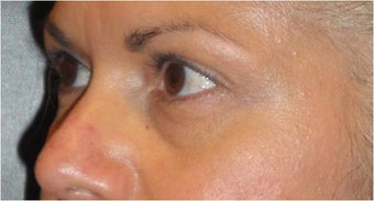 Restylane