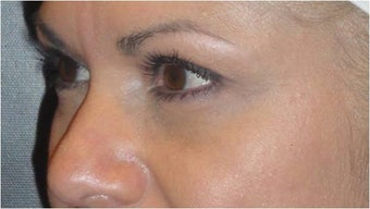 Restylane