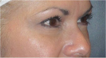 Restylane