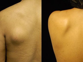 Smartlipo Triplex Lipoma Removal at Two Months
