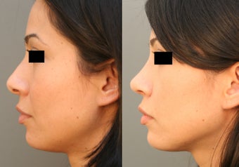 Beverly HIlls/Los Angeles Primary Rhinoplasty