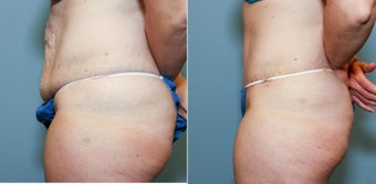 37 year old after mini tummy tuck