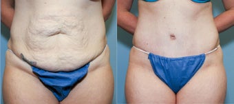 37 year old after mini tummy tuck