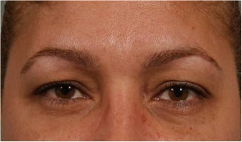 44 Year olf female with sagging of her eye brows and upper eye lids.  She doesn't want surgery