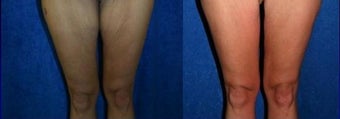 Thigh Lift after massive weight loss