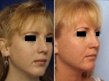 Rhinoplasty