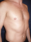 Pec Implants 