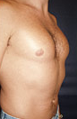 Pec Implants 