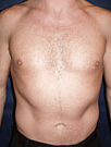 Pec Implants 