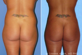 Liposuction