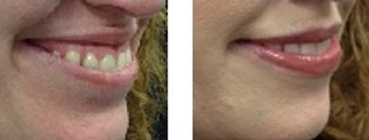 Gummy Smile Correction