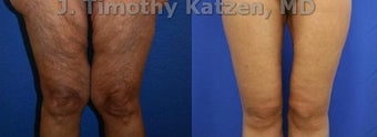 Thigh Lift after massive weight loss