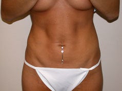 Liposuction