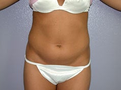 Liposuction