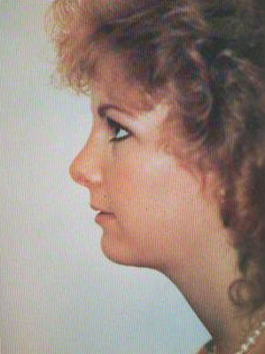 Closed Liposuction with Chin Augmentation