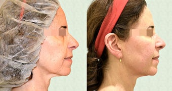 Ultherapy