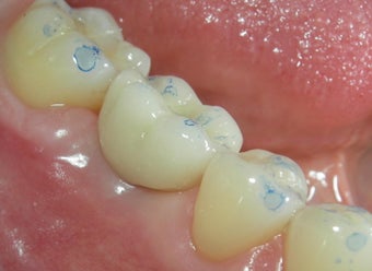 Before and After Case for Dental Implants