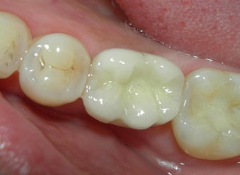 Before and After Case for Dental Implants