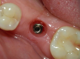 Before and After Case for Dental Implants