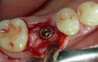 Before and After Case for Dental Implants