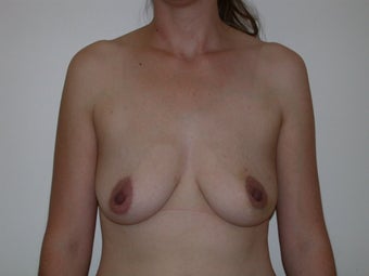 Breast reconstruction with expander and implant