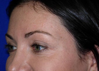 crows feet