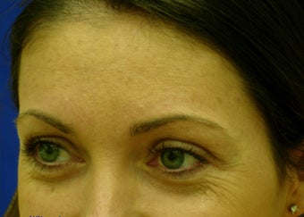 crows feet