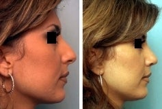 Rhinoplasty