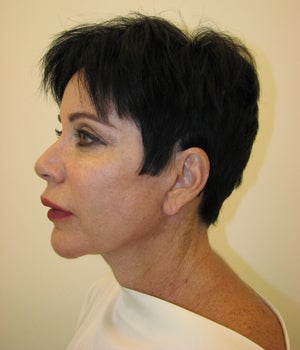 Neck Lift Before and After 