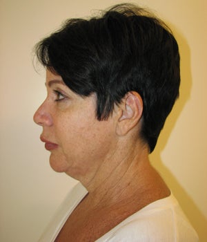 Neck Lift Before and After 