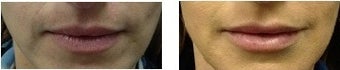 Filler for Fuller Lips