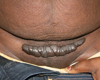 C-Section Scar Revision