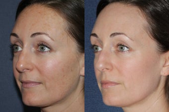 Before & After Fraxel Dual Treatment