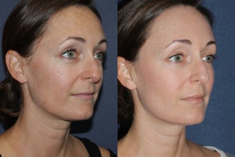 Before & After Fraxel Dual Treatment