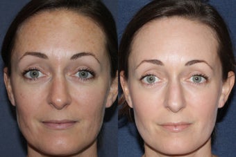 Before & After Fraxel Dual Treatment