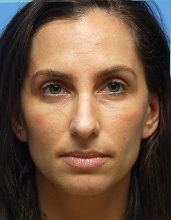 Eye Dermafillers,Cheek Dermafillers,Facial Dermafillers