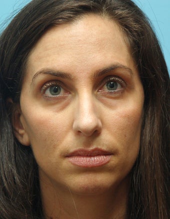 Eye Dermafillers,Cheek Dermafillers,Facial Dermafillers