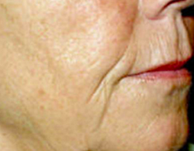 Mesotherapy
