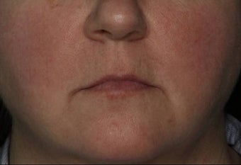 Female Treated for Rosacea/Photoaging