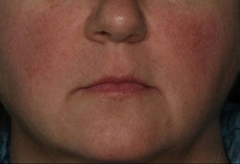 Female Treated for Rosacea/Photoaging