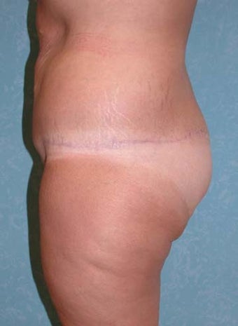 Buttock Augmentation with Circumferential Body Lift