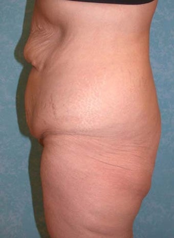 Buttock Augmentation with Circumferential Body Lift