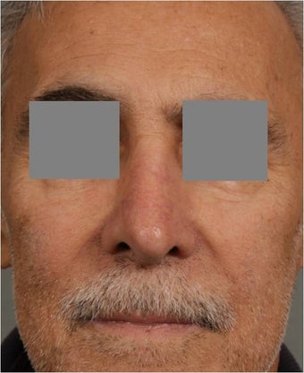 68 year old male with post rhinoplasty deformity prefers non surgical, "Injectable Rhinoplasty" treatment