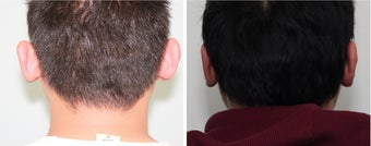 Otoplasty (Ear Surgery) Before and 2 Month After