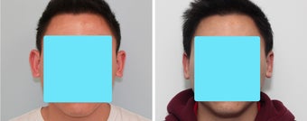 Otoplasty (Ear Surgery) Before and 2 Month After