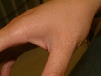 Tattoo Removal
